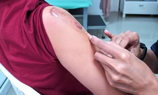 Suntik Keloid Bogor